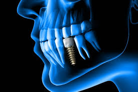 Dental Implant Advanced Procedure
