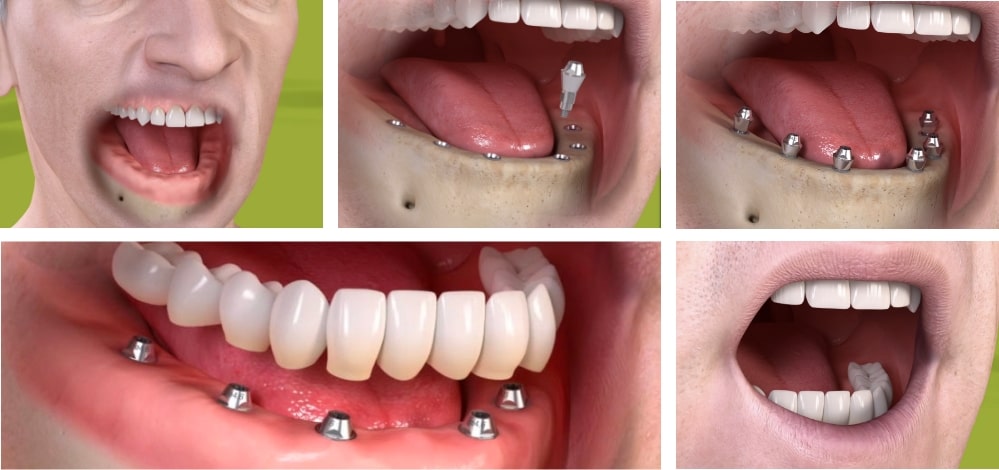 Full Mouth Fixed Teeth with Implant